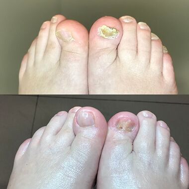 Εμπειρία στη χρήση του Promicil Cream Barnabas από το Ισραήλ, φωτογραφία πριν και μετά