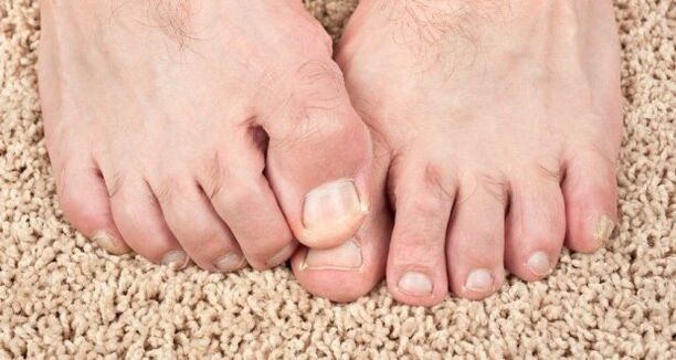 Συμπτώματα μύκητα νυχιών