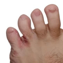 μύκητας μεταξύ των δακτύλων