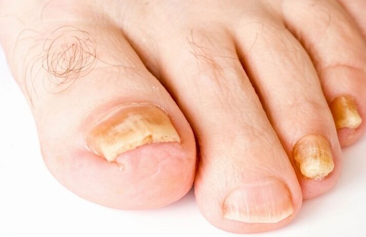 Ο μύκητας στον αντίχειρα του ποδιού