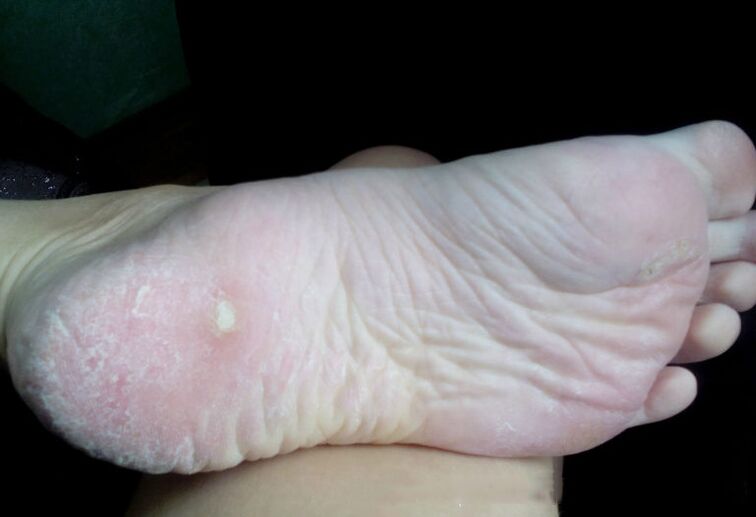 Θεραπεία του μύκητα με λέιζερ