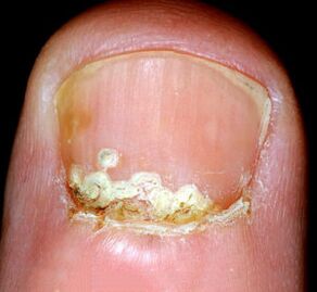 Συμπτώματα και σημεία της νόσου