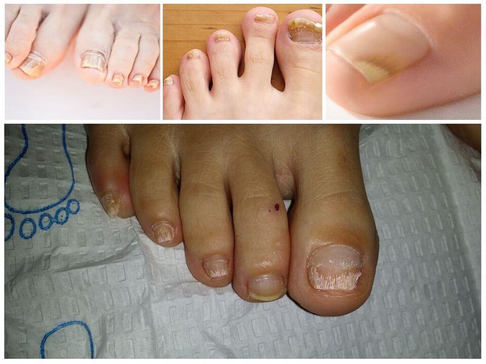 Μυκητιασικές ασθένειες των πλακών των νυχιών