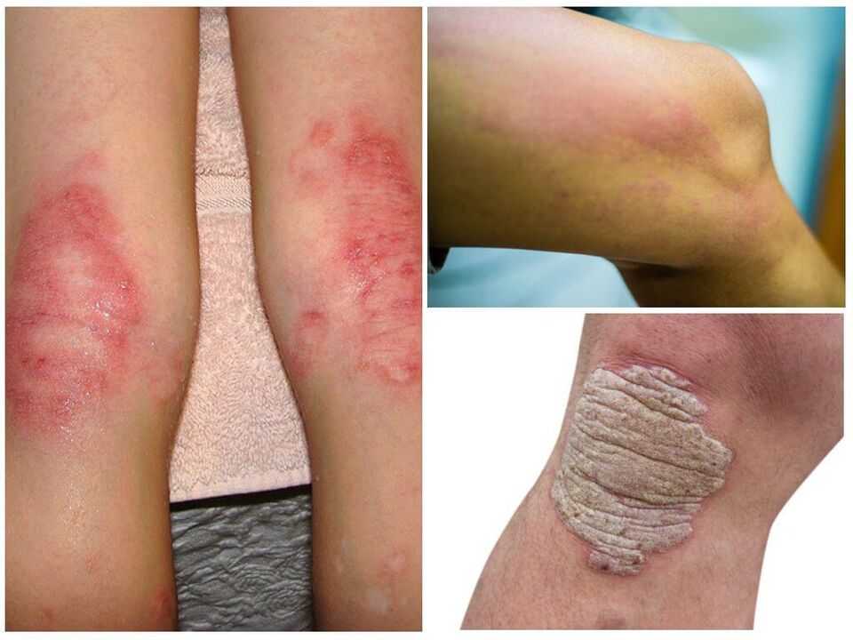 Μυκητιασικές λοιμώξεις των γονάτων