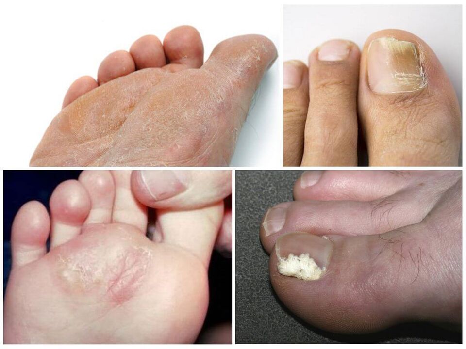 Το αρχικό στάδιο του μύκητα των ποδιών