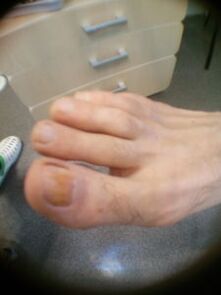 αρχικό στάδιο του μύκητα των νυχιών του μεγάλου δακτύλου