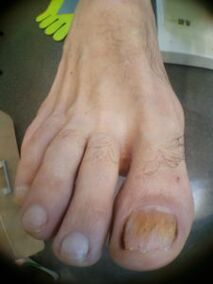 μύκητας στα νύχια του μεγάλου δακτύλου