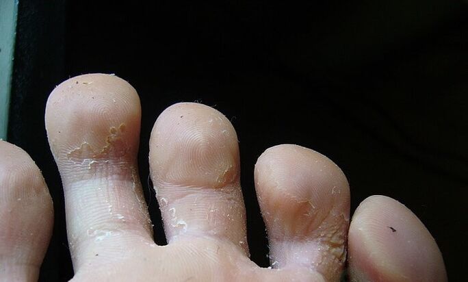 αρχικό στάδιο του μύκητα