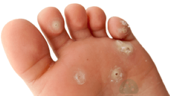 δεύτερο στάδιο μυκητιασικής λοίμωξης