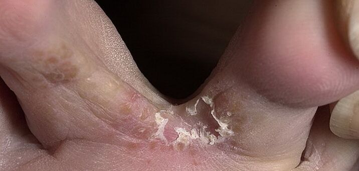 μύκητας ανάμεσα στα δάχτυλα των ποδιών