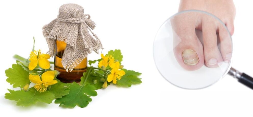Celandine για μύκητες νυχιών