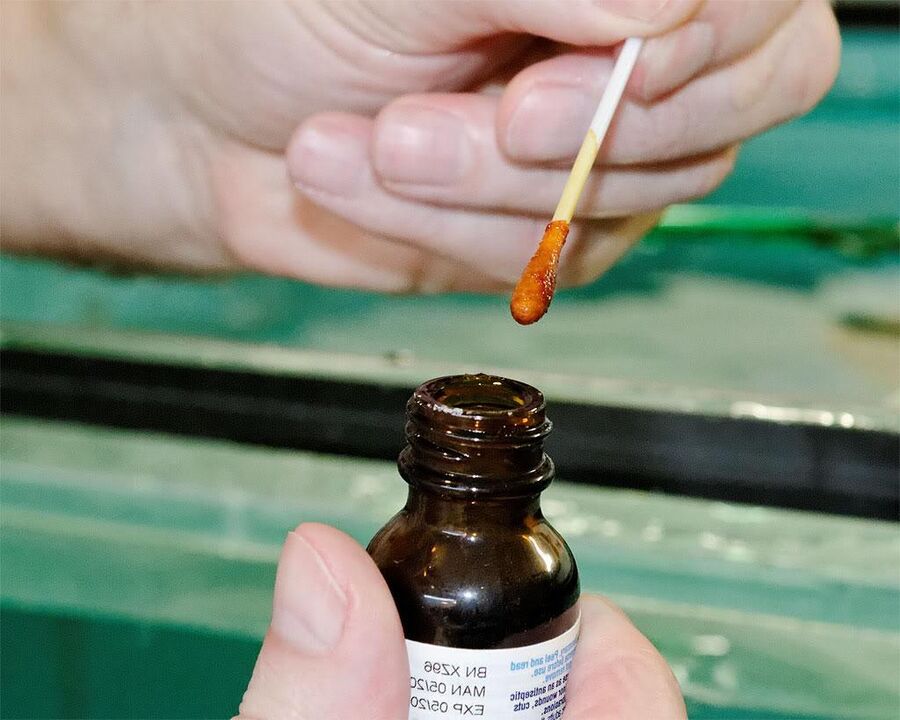 Η εφαρμογή ενός μείγματος ιωδίου και χυμού φελαντίνης στα νύχια των ποδιών θα απαλλαγεί από τους μύκητες